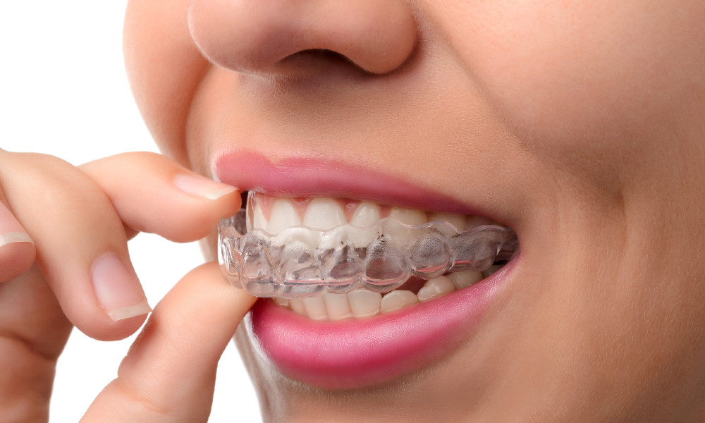 Your Top Invisalign Clear Aligner Questions Answered