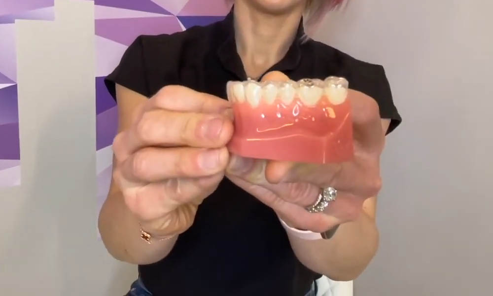 The back of one of my aligners has come away from my teeth – what do I do?